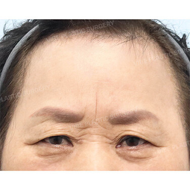 중년눈성형 Before
