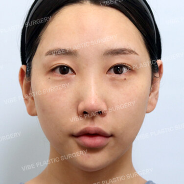 첫코성형 Before