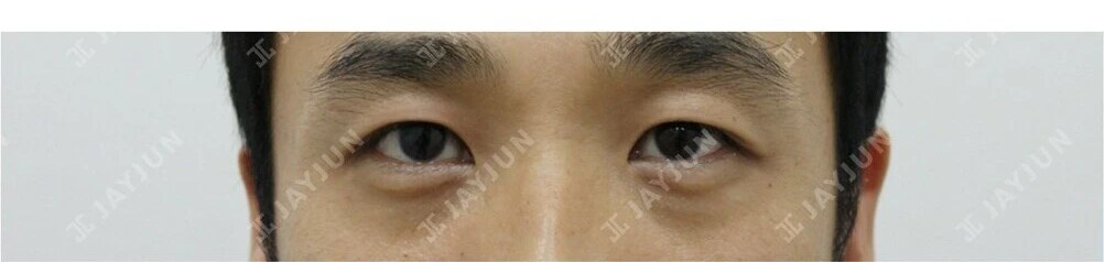 눈성형 After