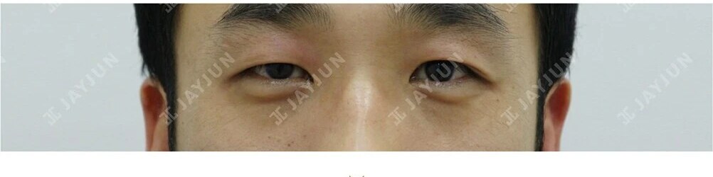 눈성형 Before