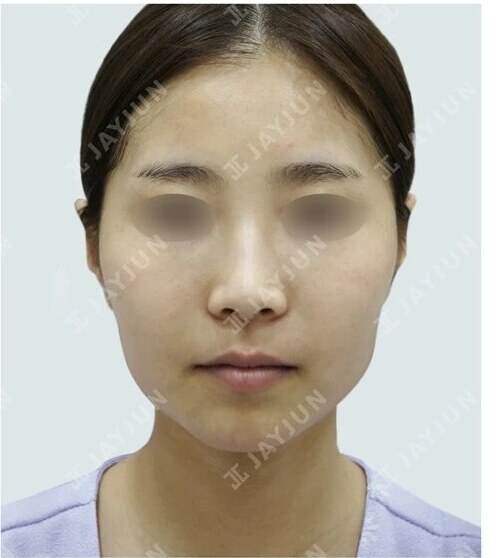 안면윤곽 Before