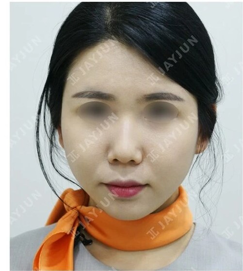 지방성형 After