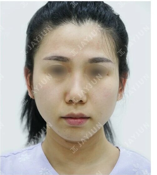 지방성형 Before