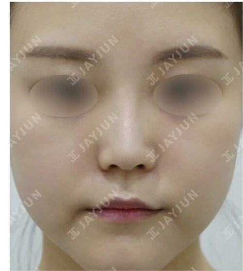 코성형 After