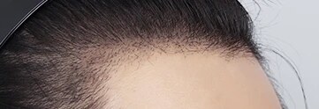 모발이식 After