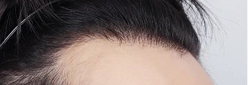 모발이식 Before