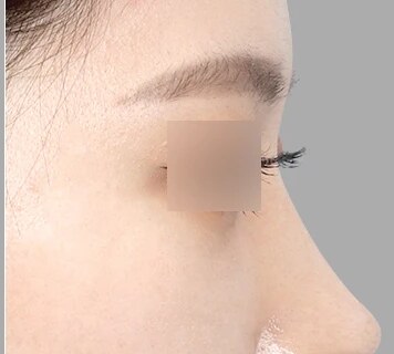 코성형 After