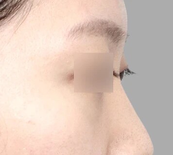 코성형 Before