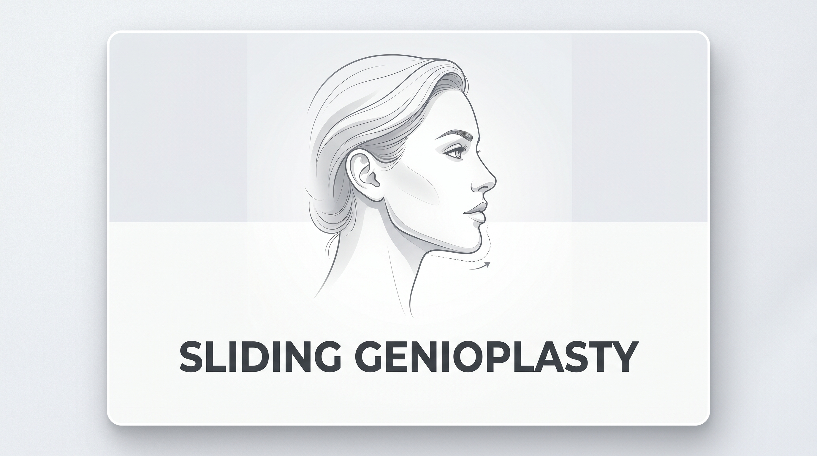Sliding Genioplasty