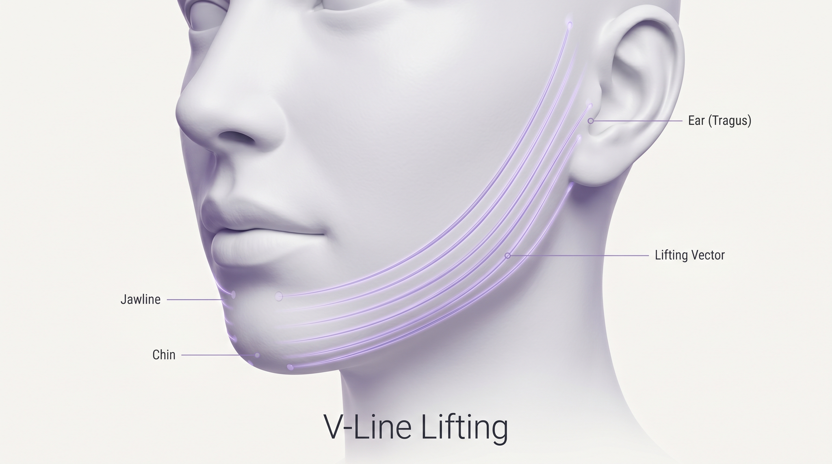 V-Line Lifting