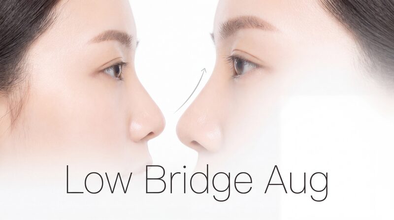 Low Nasal Bridge Augmentation