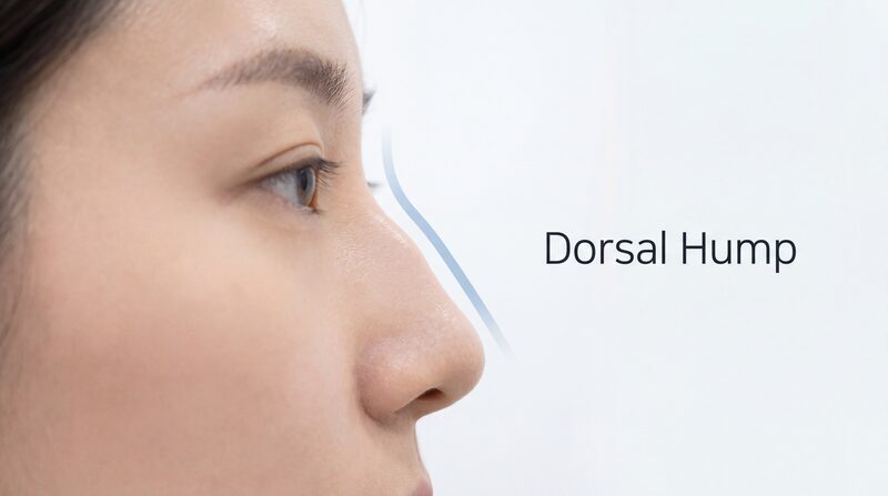 Dorsal Hump Removal