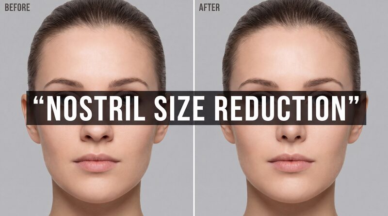 Nostril Size Reduction