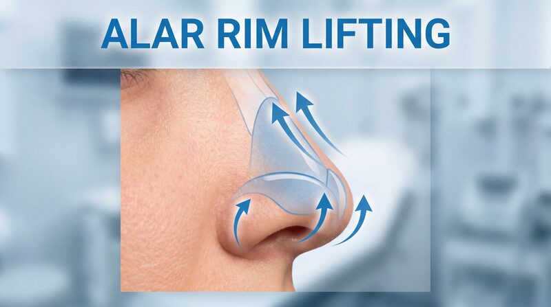 Low Alar Rim Lifting