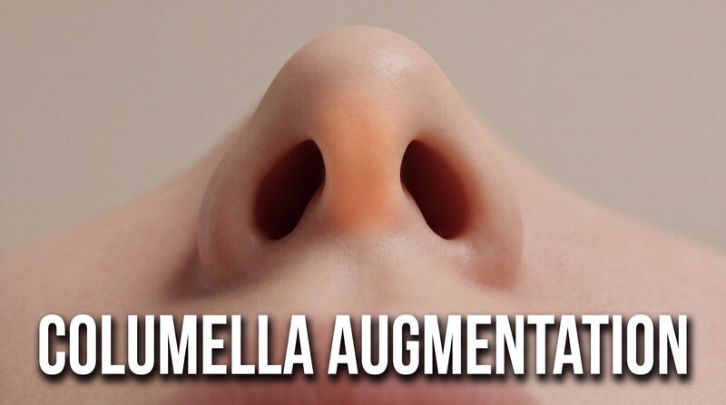 Columella Augmentation