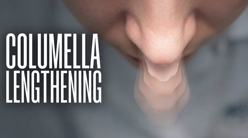 Columella Lengthening