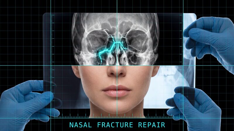 Nasal Fracture Repair