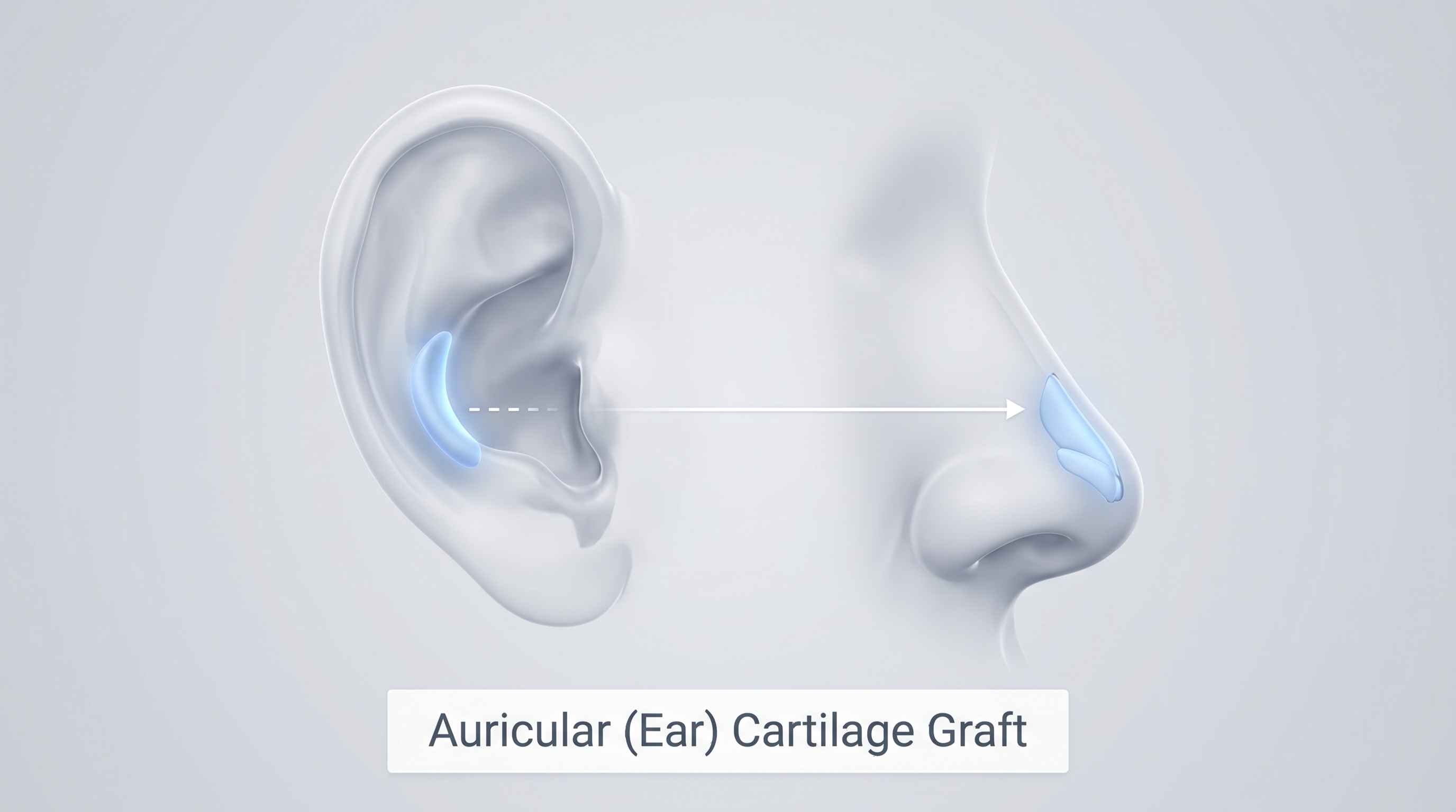 Auricular (Ear) Cartilage Graft