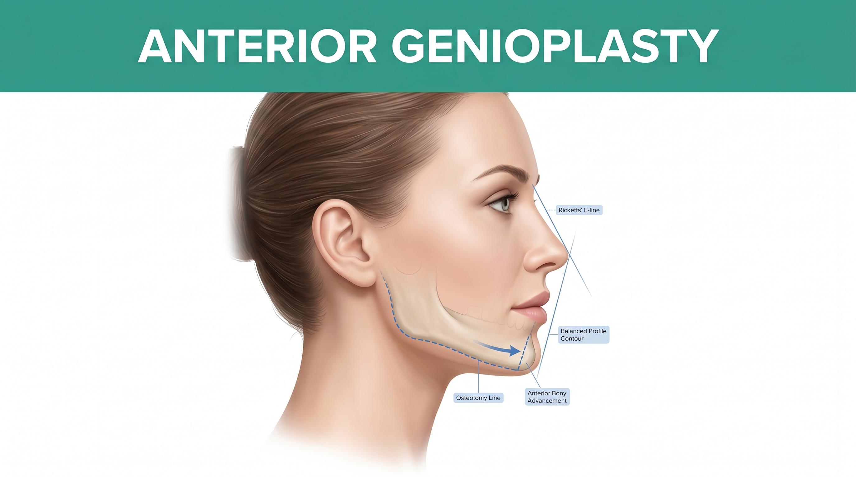 Anterior Genioplasty