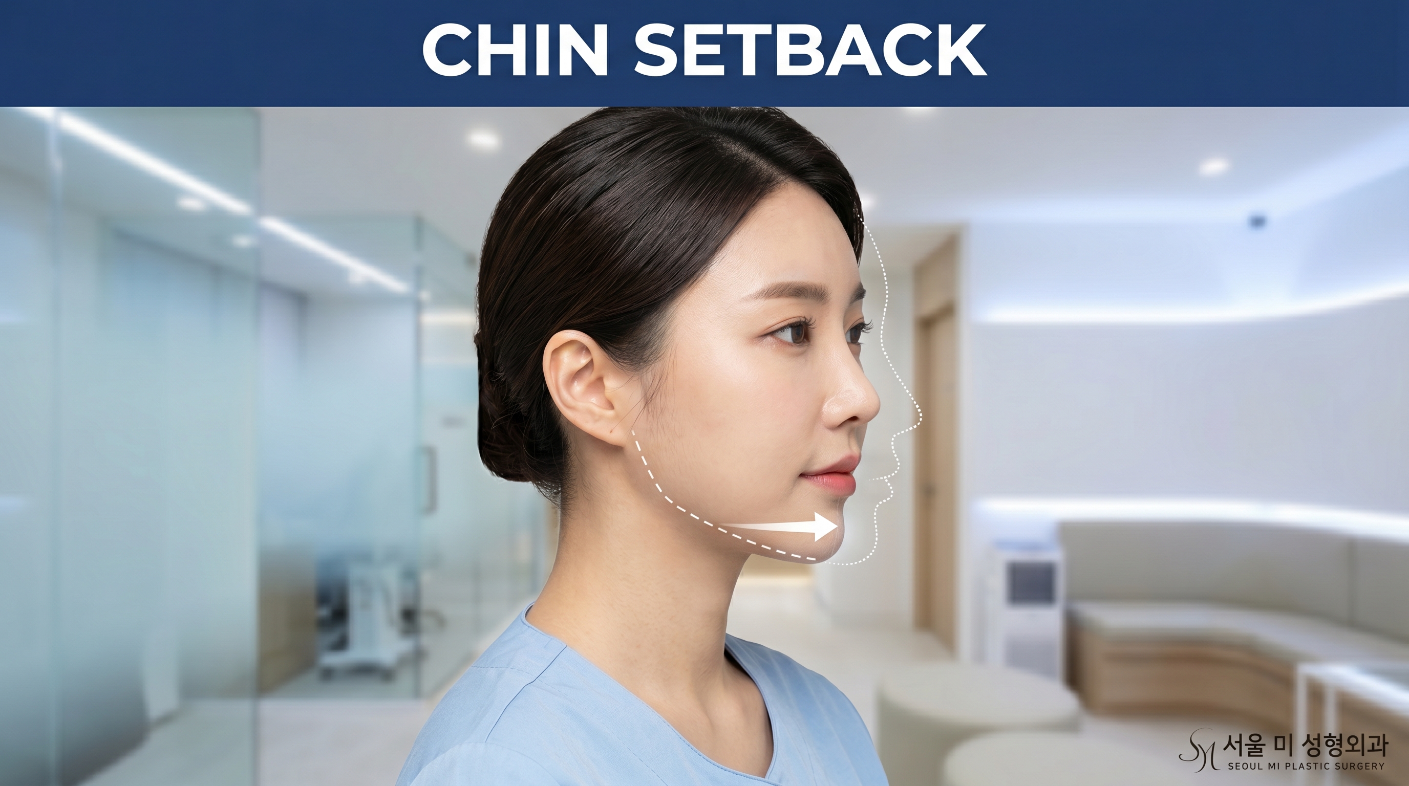 Chin Setback