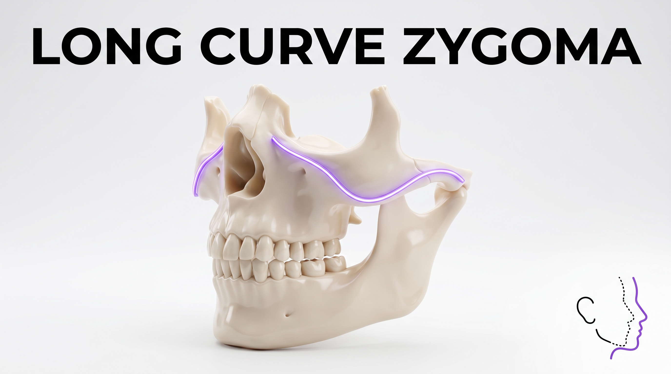 Long Curve Zygoma